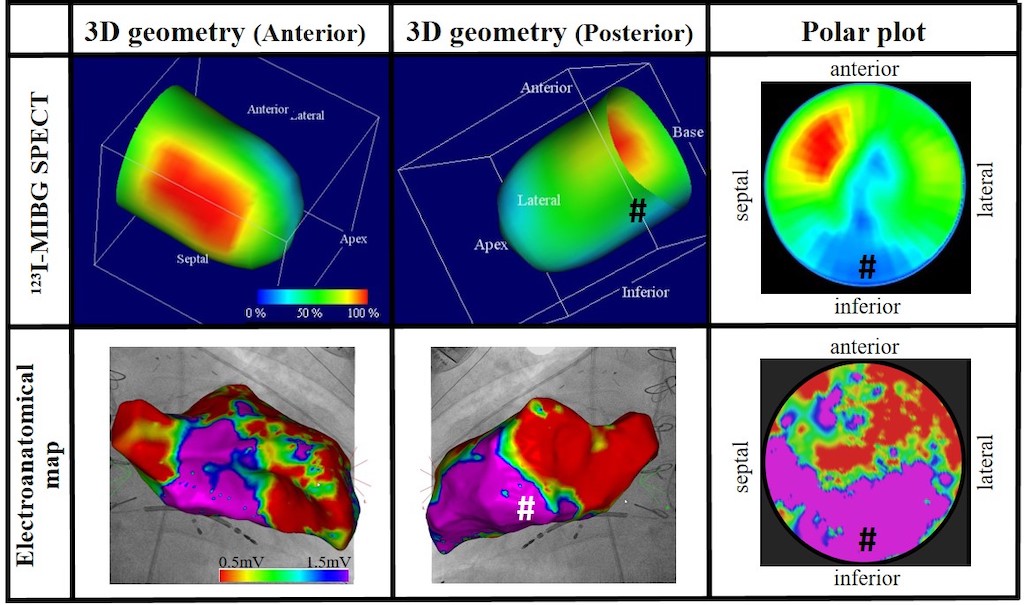 Imaging of hearts with ischemic cardiomyopathy